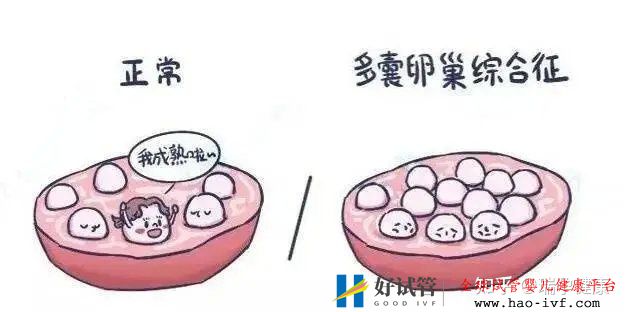 多囊想做试管这几个问题看完心里有谱了!(图6) 多囊想做试管这几个问题看完心里有谱了!(图6)