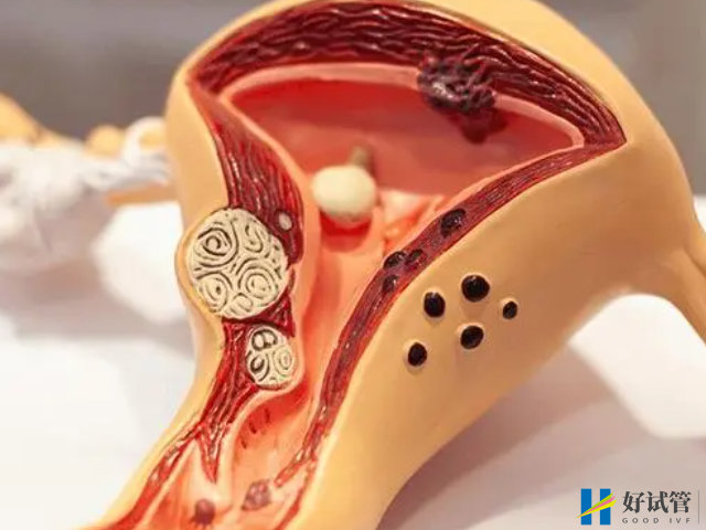 最常见的女性不孕症种类盘点,再不重视就轮到你了!(图2) 子宫内膜异位症会不孕