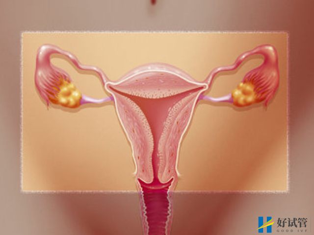 最常见的女性不孕症种类盘点,再不重视就轮到你了!(图3) 巧克力囊肿会导致不孕