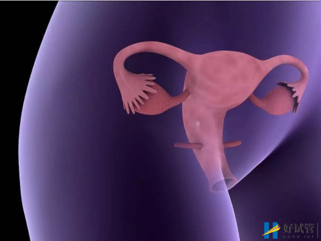 女性输卵管积水形成原因不简单,与这4个因素有直接关系(图1) 输卵管积水会导致不孕