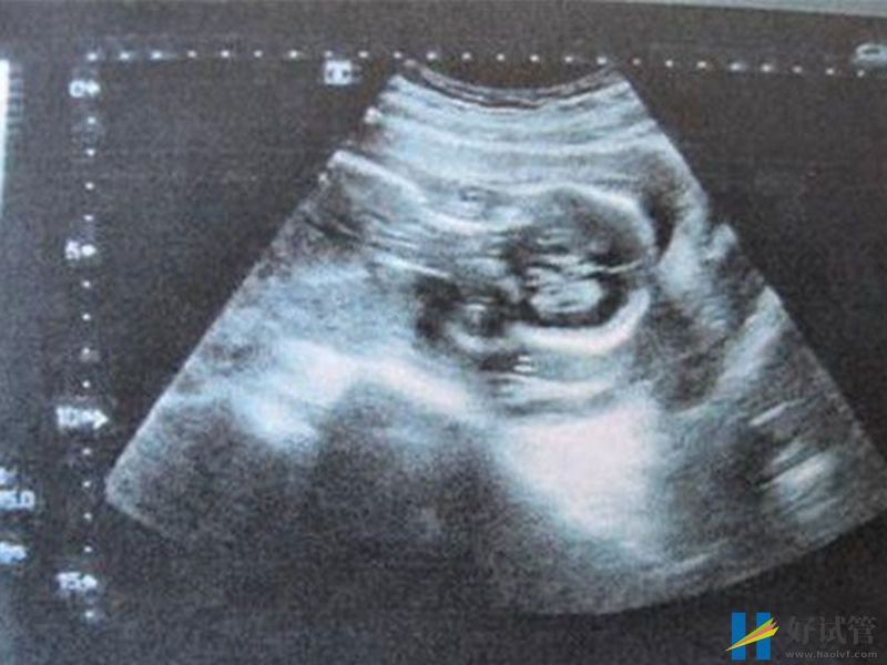 nt值2.9mm不正常!胎儿可能存在先天性疾病(图1) 胎儿畸形和nt值偏高有强相关性