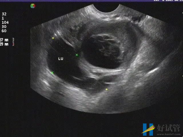 输卵管堵塞三种类型详解,不同程度检查及治疗方法均不同(图1) 输卵管堵塞发病率高