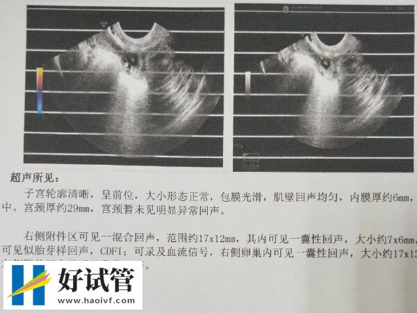 一代试管婴儿鲜胚为什么在宫外着床?或是激素异常所致(图1) 试管宫外孕的原因有哪些