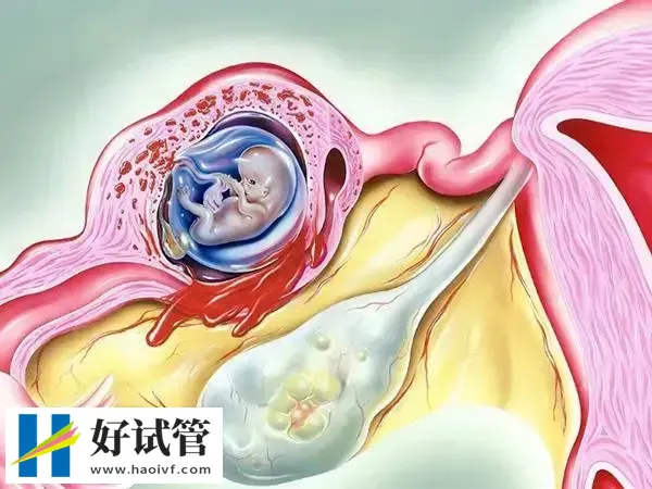 囊胚移植21天为什么要做B超(图1) B超检查观察宫外孕准确率高