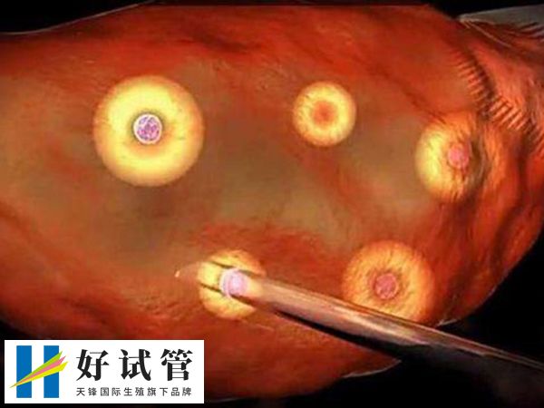 取卵后一个月卵巢是否恢复了(图1) 取卵后一个月卵巢是否恢复了(图1)