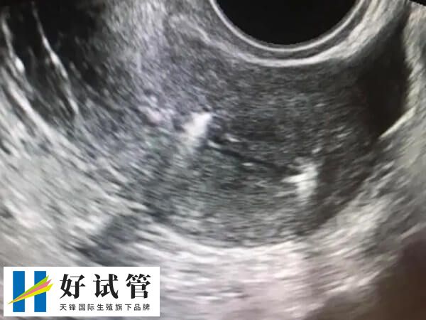 哪些因素影响试管着床率(图2) 宫腔环境会影响胚胎移植的成功率