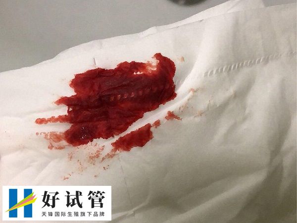 胚胎移植后出血可能是着床出血