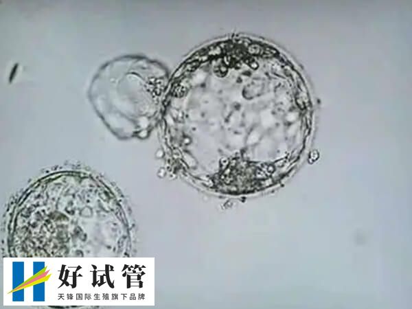 试管2pn与2pb分别什么意思(图1) 2pb是受精异常胚胎