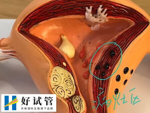 子宫腺肌症打达菲林有没有效果(图3) 子宫腺肌症是一种常见的妇科疾病