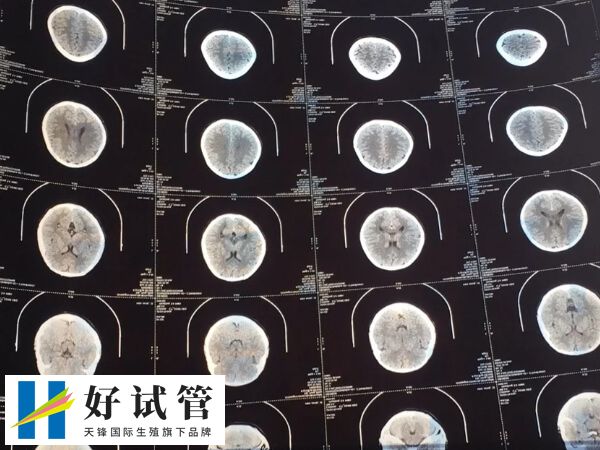 多发性骨软骨瘤做试管婴儿会不会遗传(图3) 多发性骨软骨瘤是一种常染色体显性遗传病